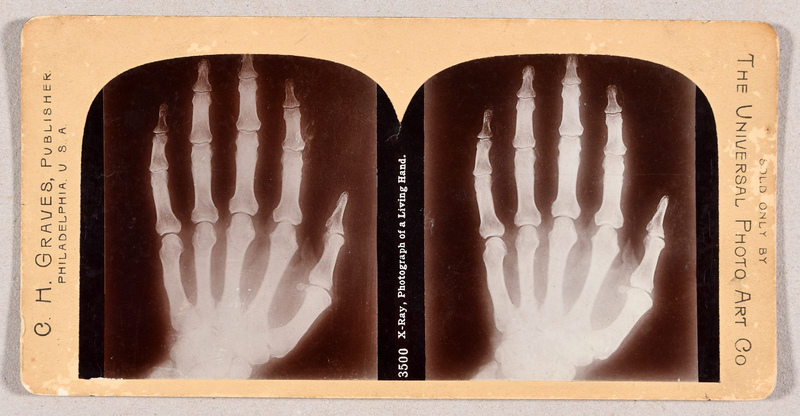 2 stereoscopic views.